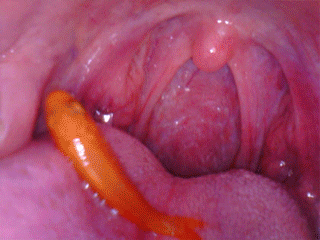 endoscope mouth throat