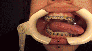 braces retractor mouth braces vore