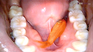 endoscope goldfish swallow